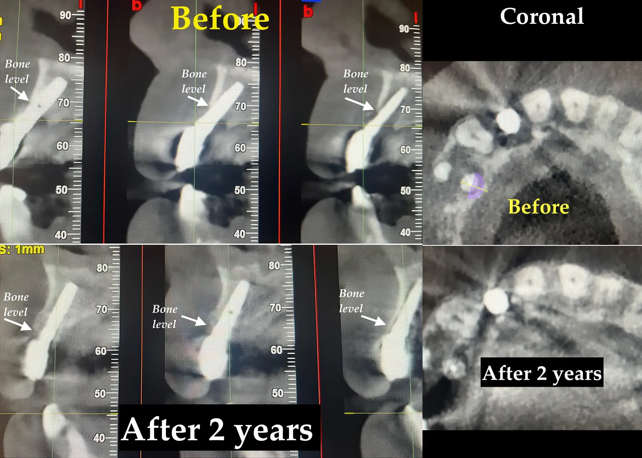 Confronto radiografico prima e dopo il trattamento della peri-implantite con tecnica TST: CBCT e periapicali a 2 anni