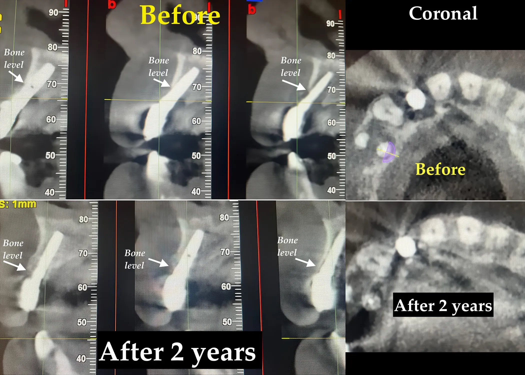 Confronto radiografico prima e dopo il trattamento della peri-implantite con tecnica TST: CBCT e periapicali a 2 anni