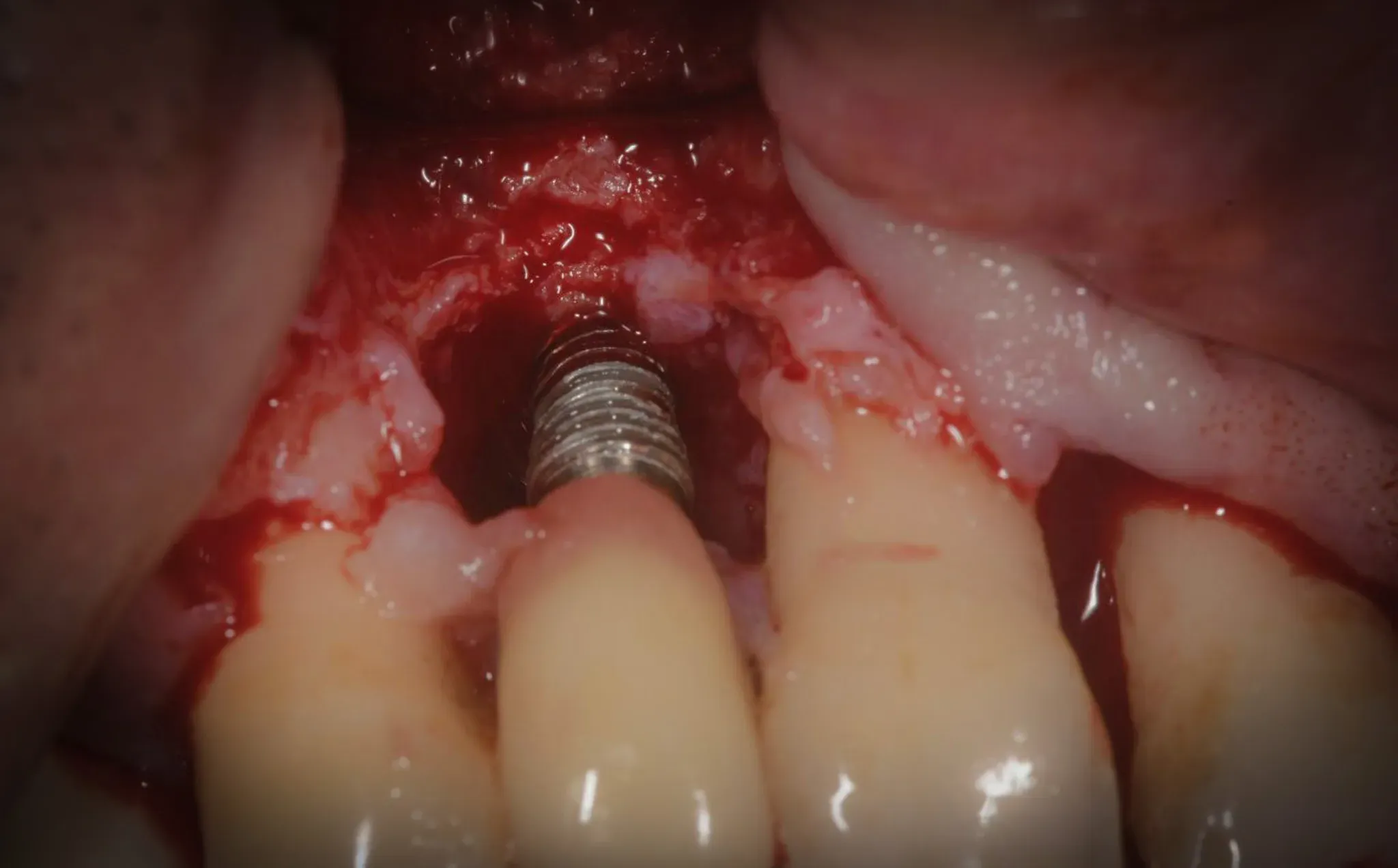 Campo operatorio dopo decontaminazione TST: il precipitato bianco sulla superficie implantare è visibile. Difetto crateriforme esposto