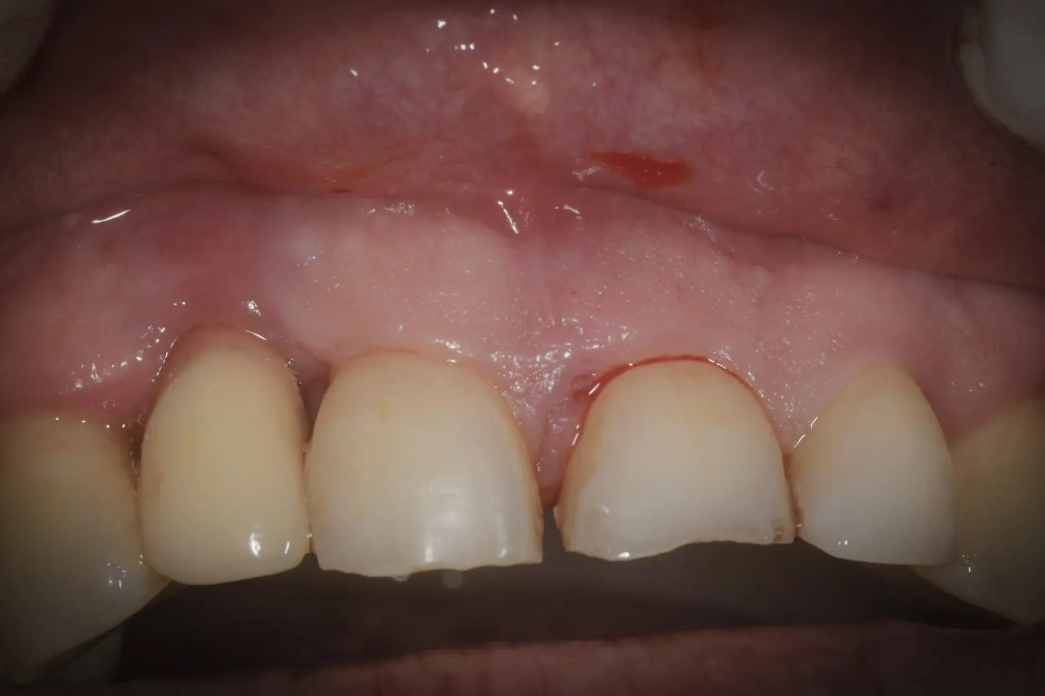 Situazione preoperatoria: impianto in 1.1 con peri-implantite e coinvolgimento parodontale dei denti adiacenti