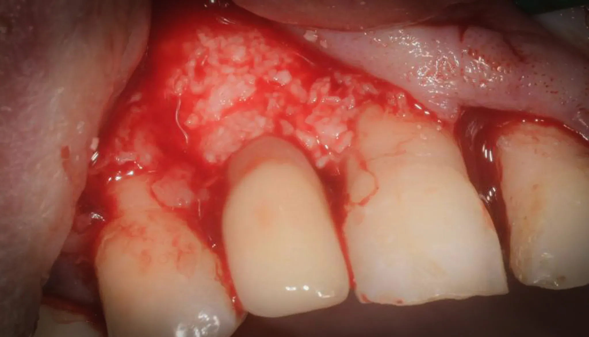 Innesto di osso eterologo collagenato con colla di fibrina nel difetto peri-implantare