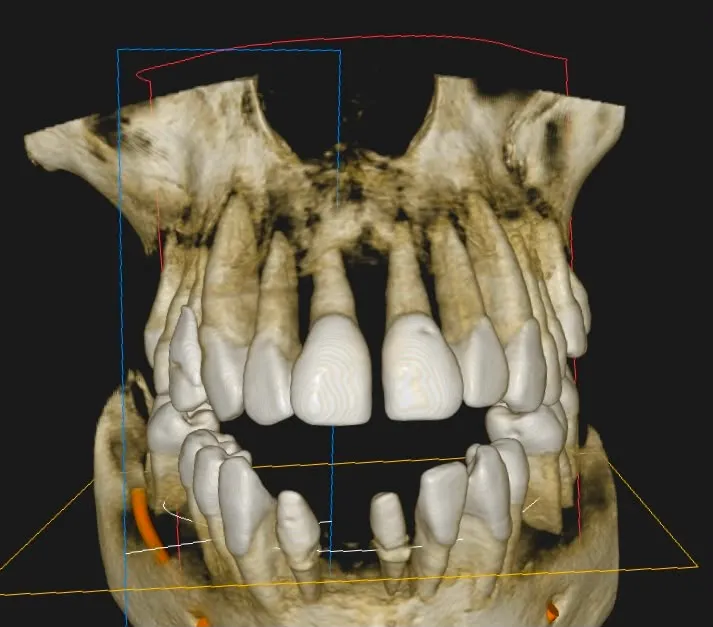 Ricostruzione CBCT 3D: migrazione vestibolare degli elementi e grave perdita di supporto osseo