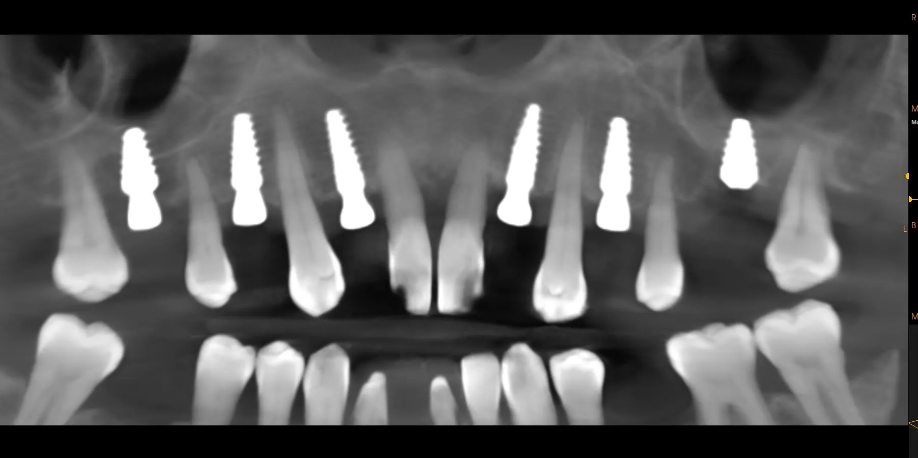 Ortopantomografia post-operatoria: sei impianti mascellari inseriti con denti residui 17 e 27 ancora in situ come pilastri provvisori