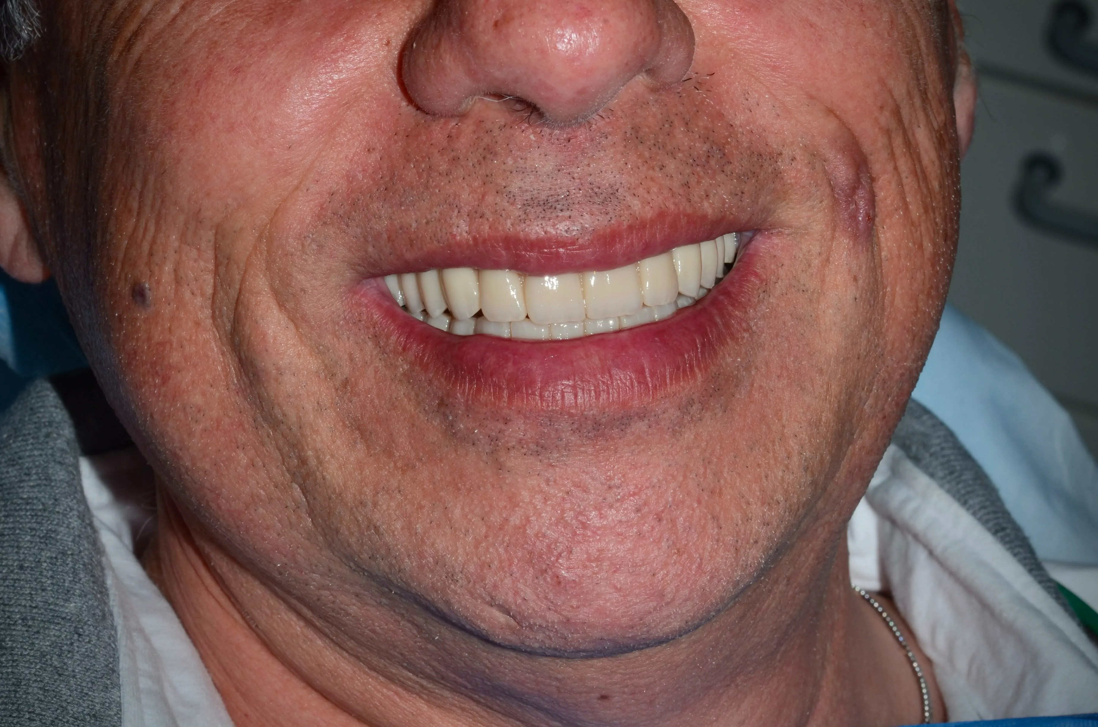 Risultato finale: il sorriso del paziente dopo la riabilitazione mascellare completa