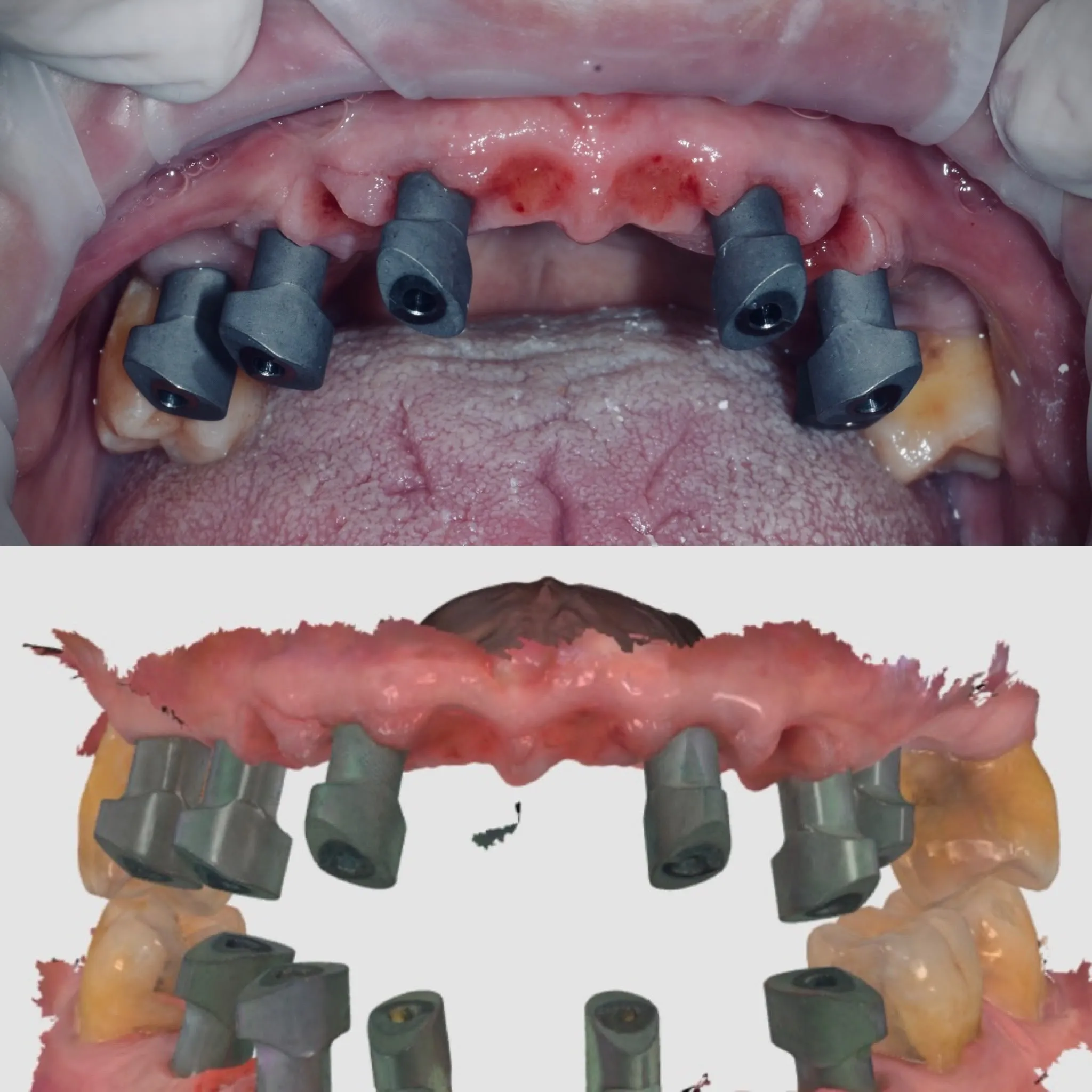 Sopra: scan bodies posizionati per l'impronta digitale. Sotto: scansione intraorale 3D