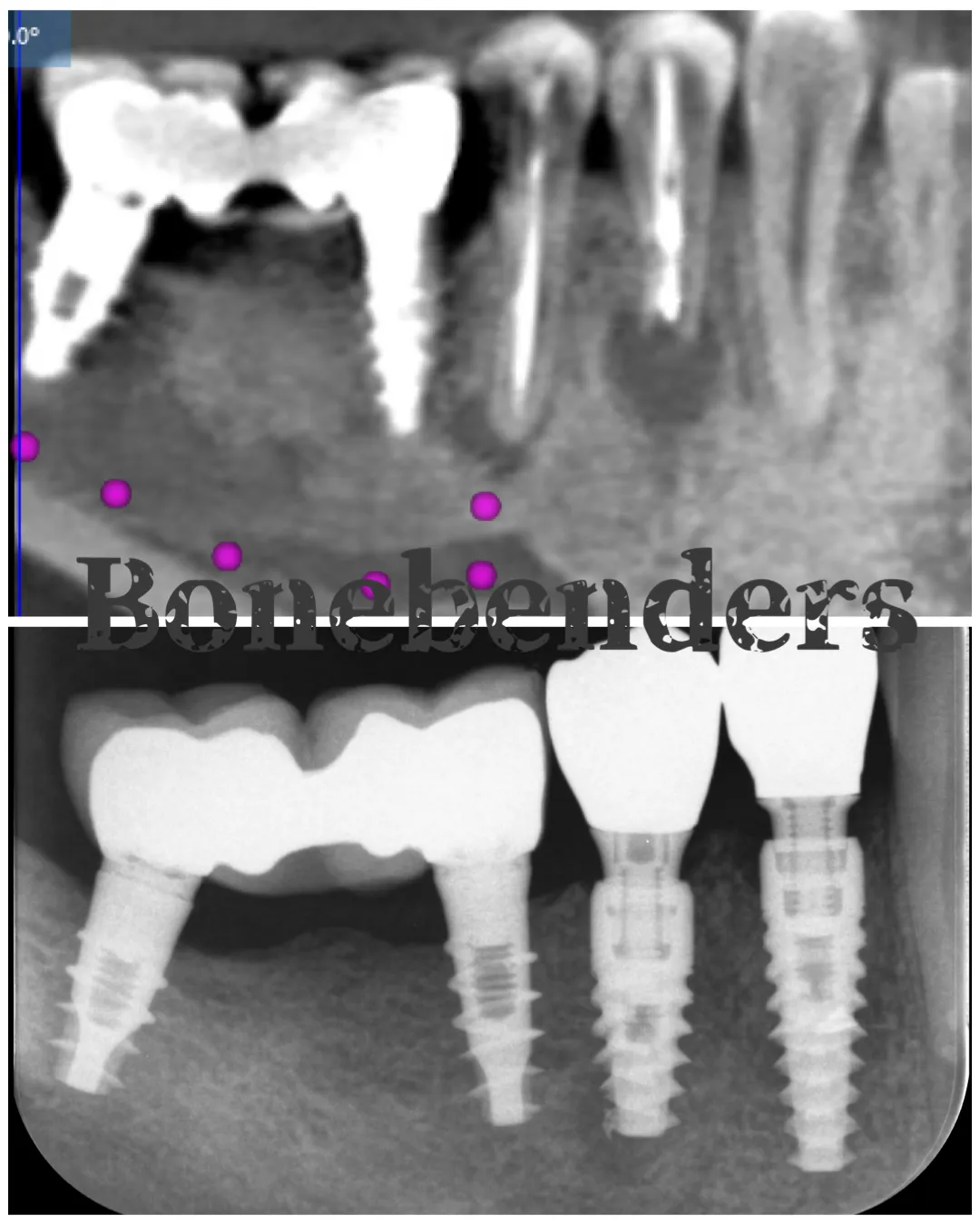 un-impianto-immediato-e-sempre-la-soluzione-migliore-per-sostituire-un-dente-indipendentemente-dal-difetto-osseo