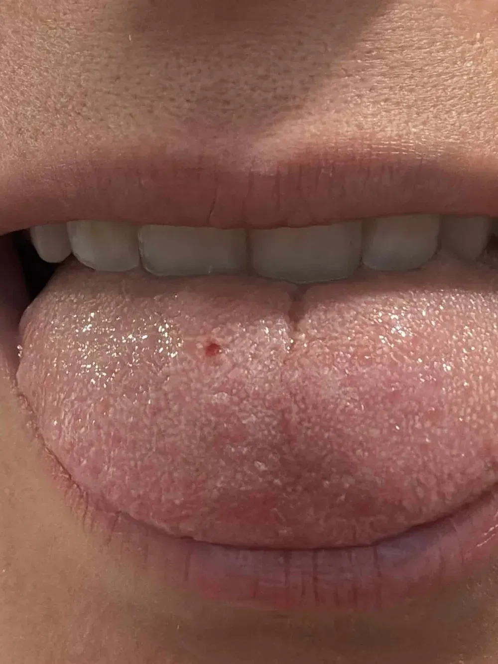 Vista ravvicinata di una bocca con labbra e lingua visibili, mostrando una leggera irritazione sulla lingua.