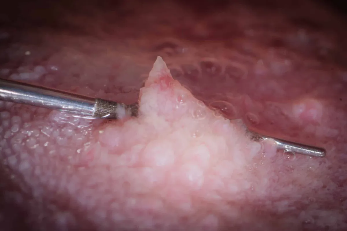 una-piccola-grande-storia-dimostra-lefficacia-dei-vaccini