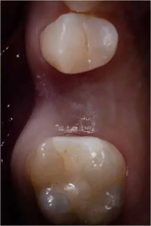 Immagine ravvicinata di una zona edentula