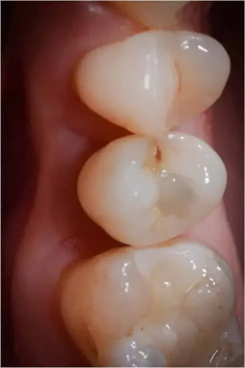 Prossimità di denti umani con un impianto nel mezzo