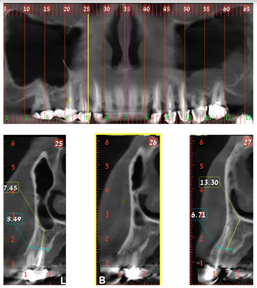 Classe 1: la sezione numero 26, in giallo, delimita il confine distale della cavità nasale e si trova sopra la parte distale del canino. Da Yahya et al. (2021). Licenza CC4.0.