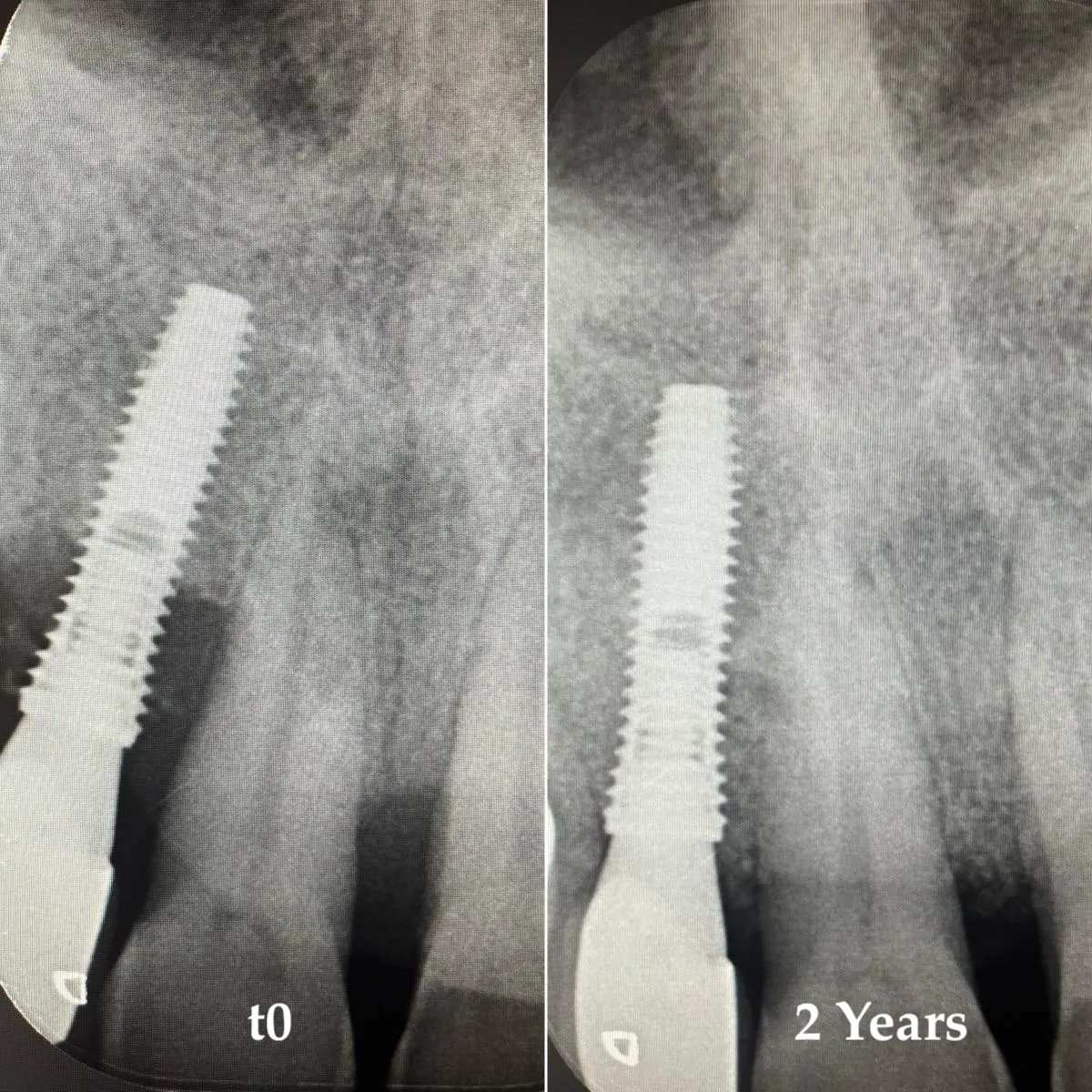 Radiografie periapicali: confronto prima del trattamento e a 2 anni di follow-up. Fill osseo visibile nel difetto peri-implantare